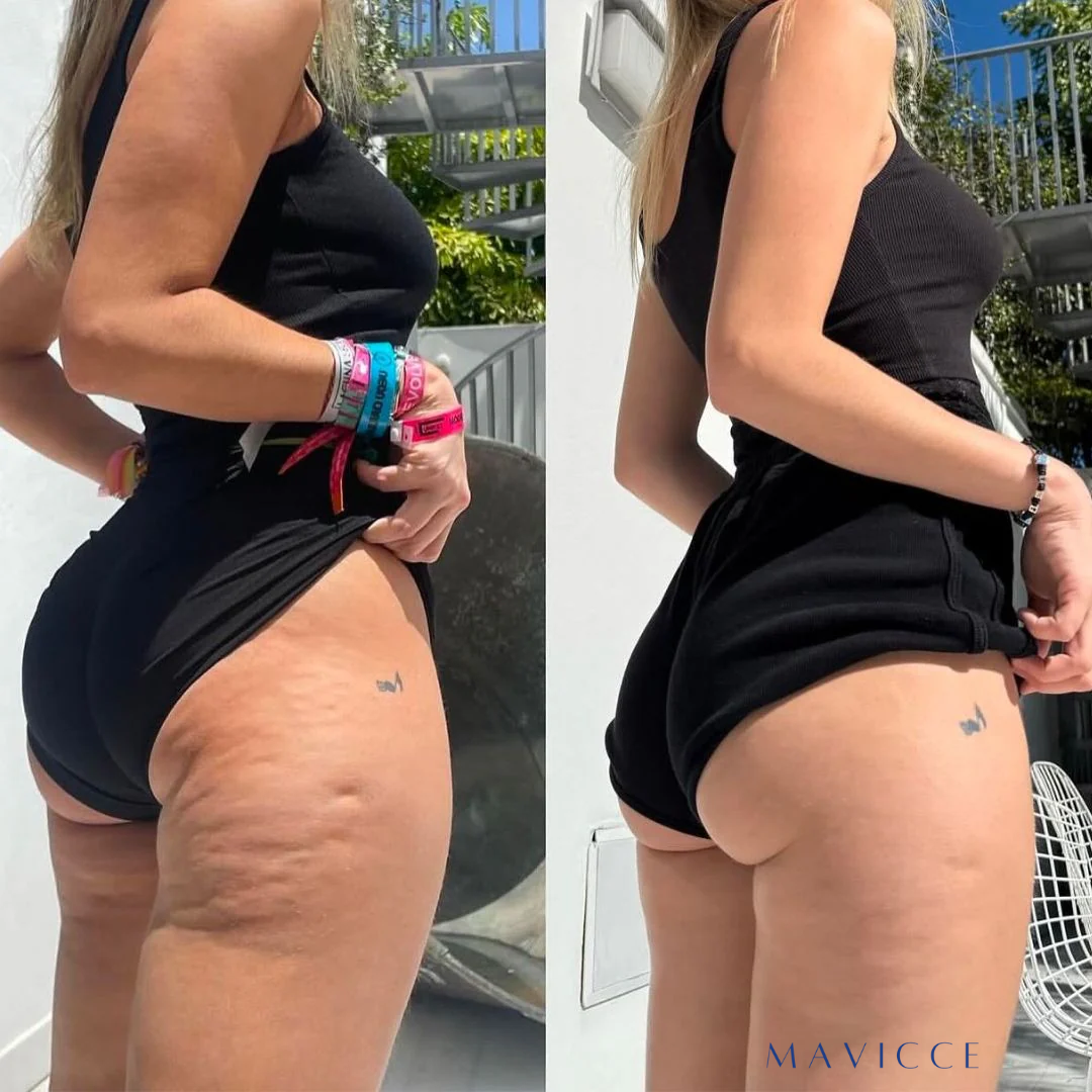 SlimPress™ - Masajeador anti celulitis