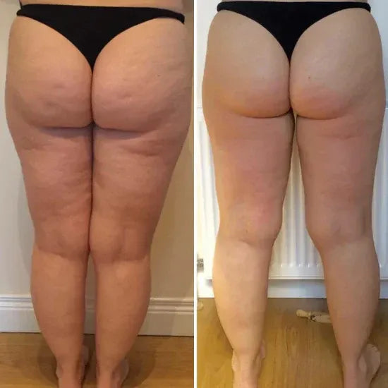 SlimPress™ - Masajeador anti celulitis