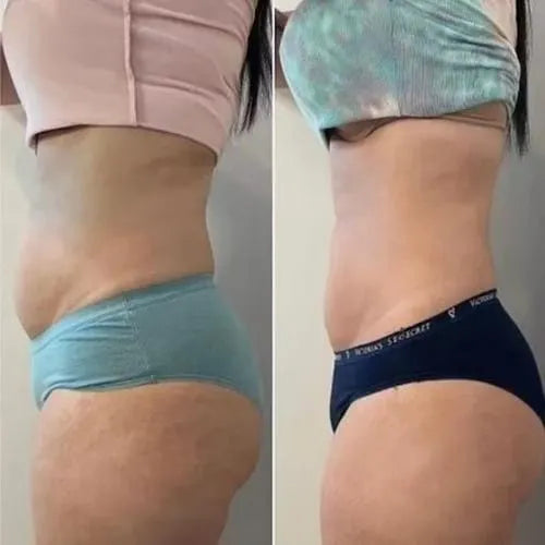 SlimPress™ - Masajeador anti celulitis